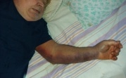 В новомосковской больнице пенсионер получил вывих и попал в реанимацию: прокуратура проводит проверку