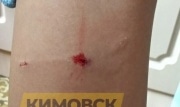 В Кимовске 14-летнюю девочку покусала собака